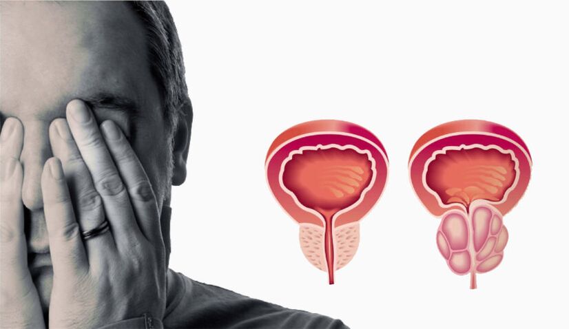 Chronische Prostatitis