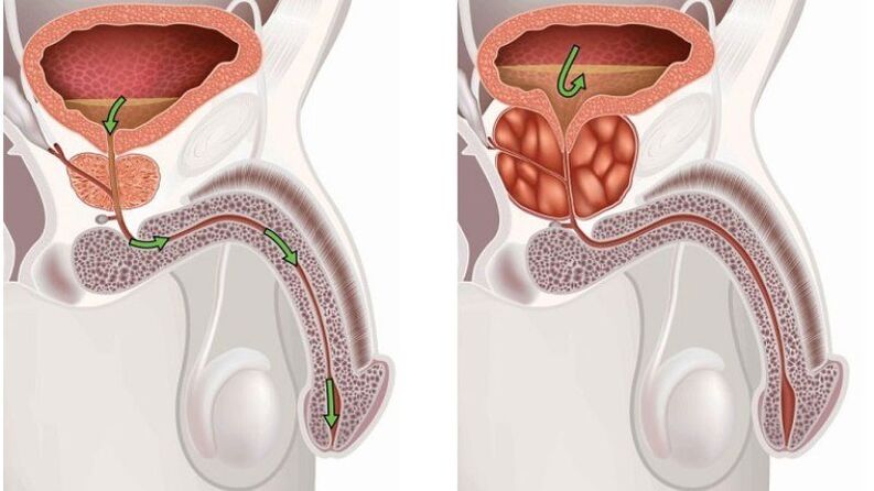 gesunde, entzündete Prostata mit Prostatitis
